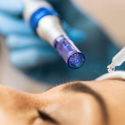 Nahaufnahme Microneedling Gerät
